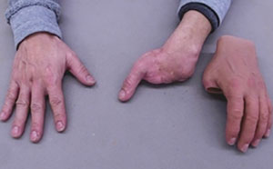 装着例：40代男性（左2,3,4,5指 手首割り無し差し込み式）
