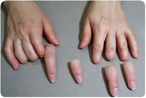 装着例：40代女性(右2指手指義手・左2，3，4指手指義手ショートタイプ)